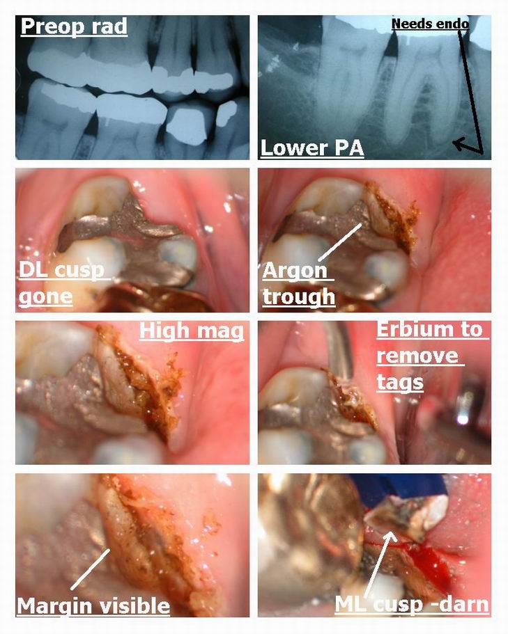 Resize of Fractured tooth osseous recontouring pg 1.jpg